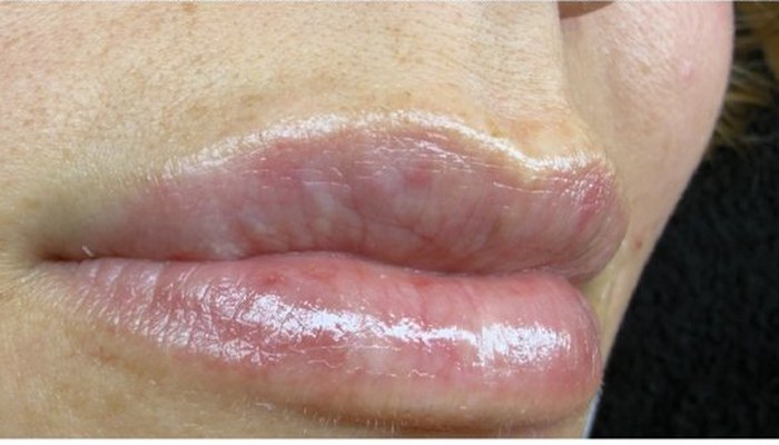 Antes de micropigmentación de labios